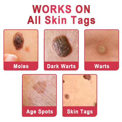 KISSHI™ WipeOffEase Tags & Moles Remover